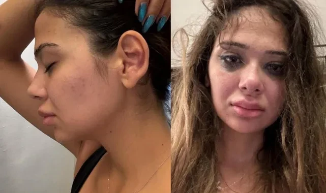 Merve Taşkın gördüğü şiddeti paylaştı: Burnumu yumrukladı, cinsel organıma tekme attı