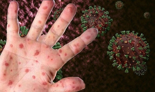 TTB: Türkiye’de şimdiye kadar 12 kişiye M çiçeği enfeksiyonu tanısı konuldu